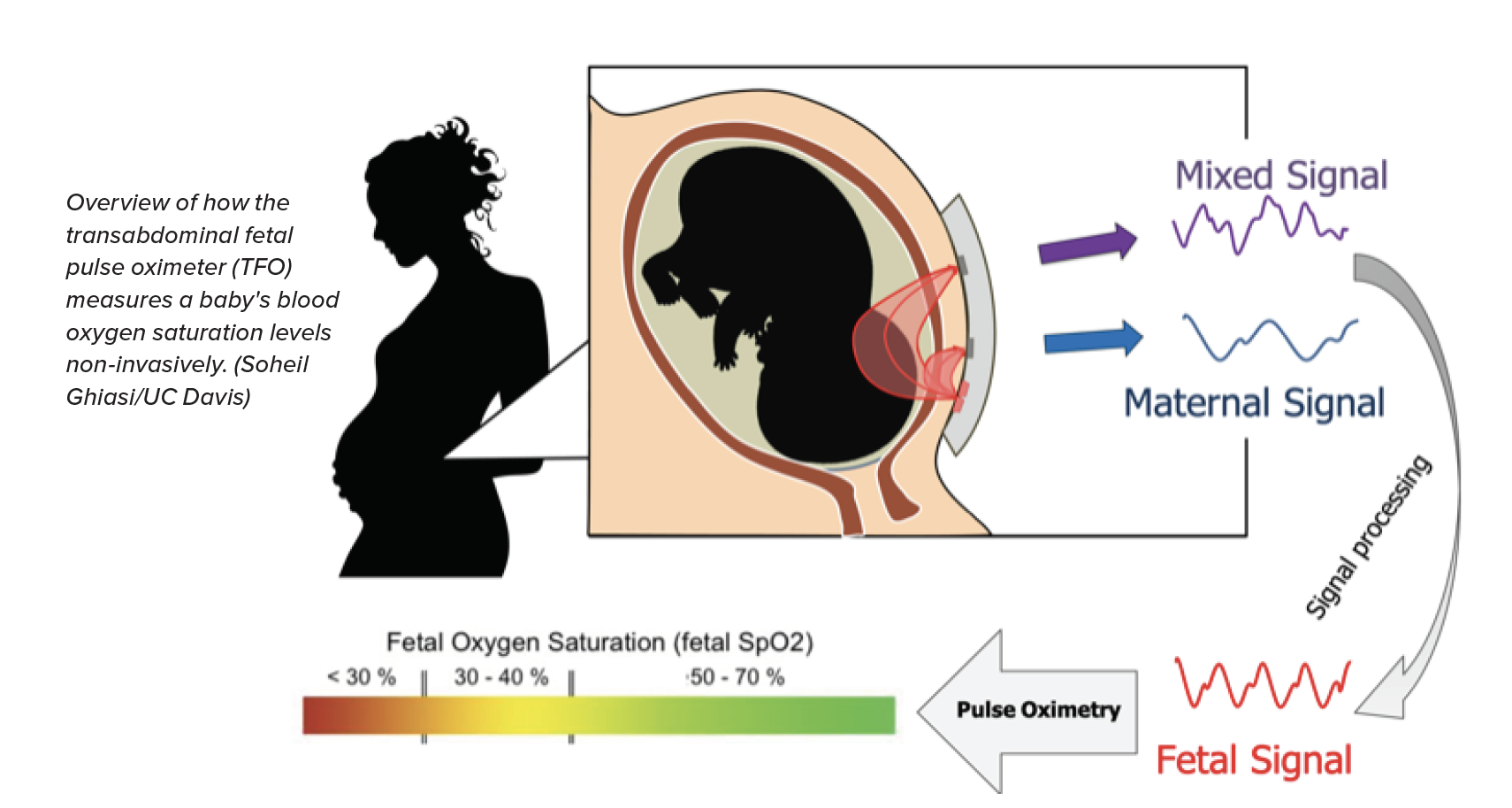 transabdominal fetal pulse oximeter 