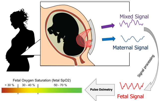 overview of how transabdominal fetal pulse oximeter works