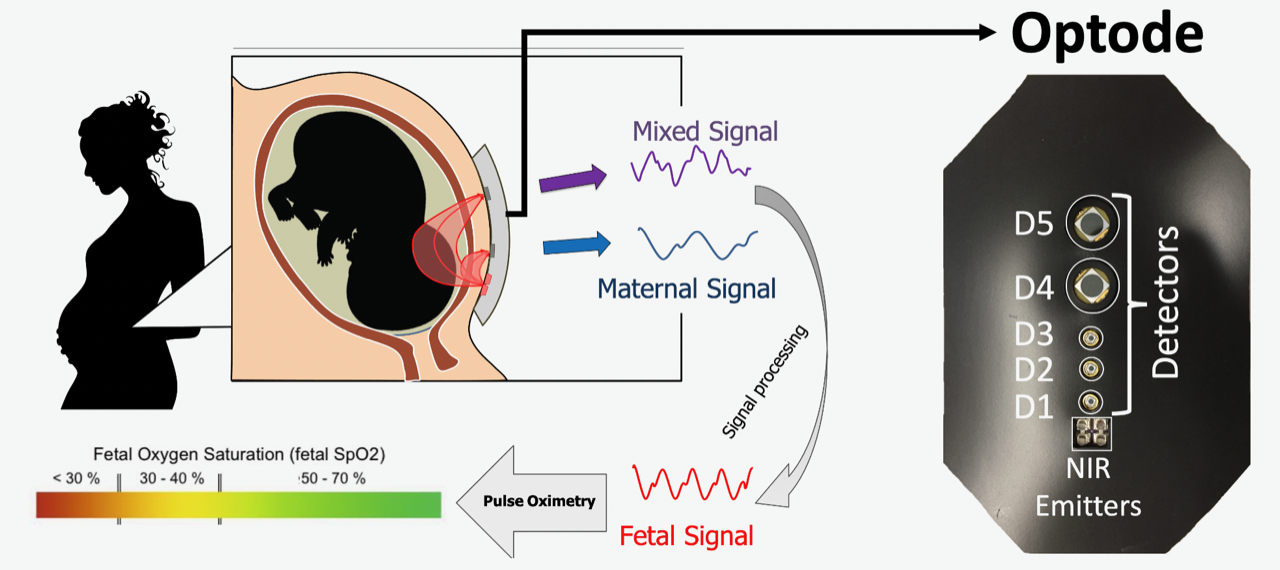 transabdominal fetal pulse oximeter overview